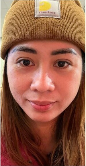 After acne treatment at Le Miracle Skin Clinic Ottawa, front view