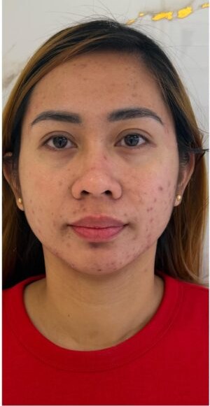 Before acne treatment at Le Miracle Skin Clinic Ottawa, front view