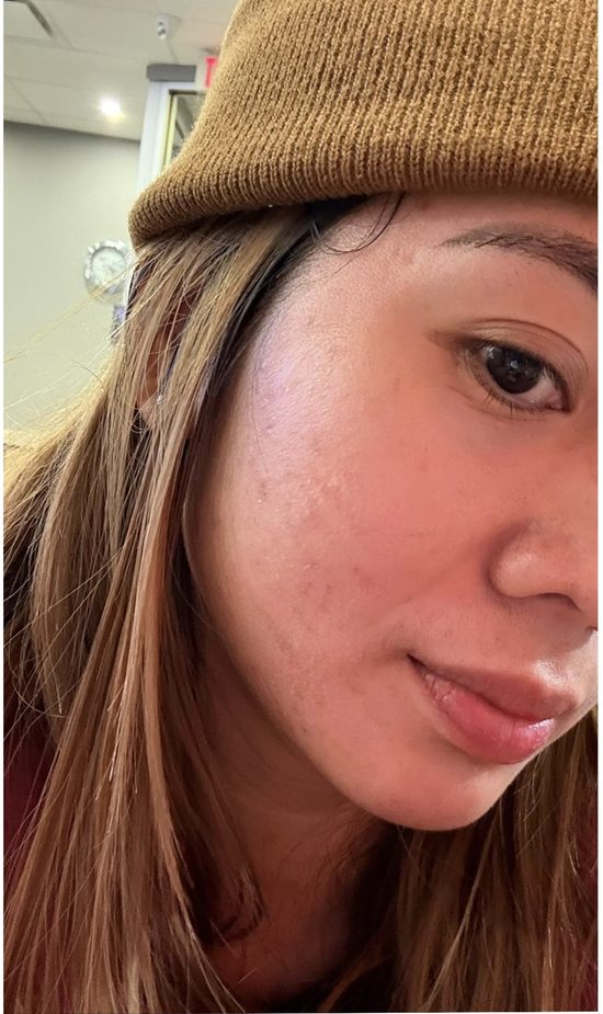 After acne treatment at Le Miracle Skin Clinic Ottawa, side view
