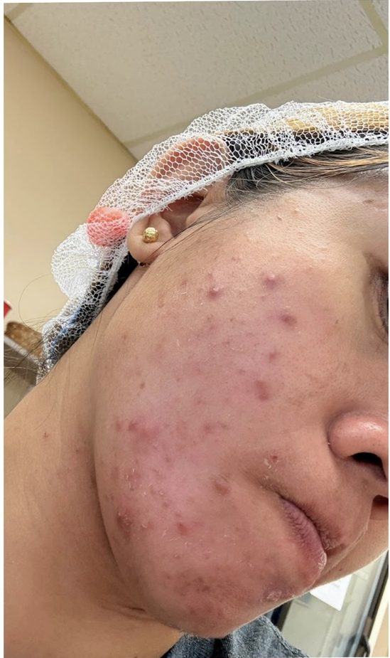 Before acne treatment at Le Miracle Skin Clinic Ottawa, side view
