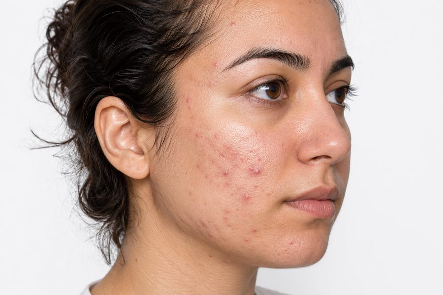 Acne before treatment