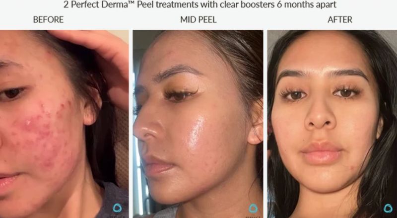 Breakouts before, mid-peel and after two Perfect Derma Peel treatments with Clear boosters. Photo supplied by The Perfect Derma.