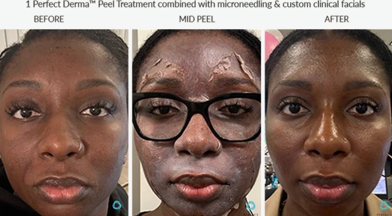 Uneven tone and texture before, mid-peel and after one Perfect Derma Peel with microneedling and clinical facials. Photo supplied by The Perfect Derma.