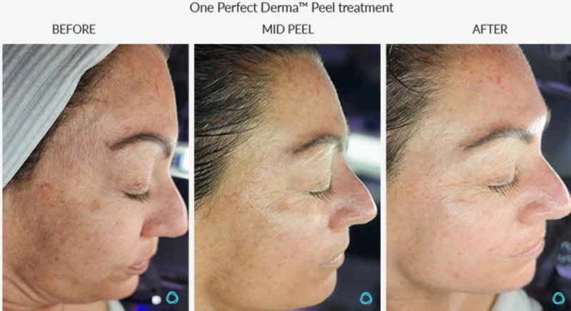 Pigmentation and uneven tone before, mid-peel and after one Perfect Derma Peel. Photo supplied by The Perfect Derma.