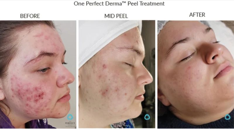 Cheek breakouts before, mid-peel and after one Perfect Derma Peel. Photo supplied by The Perfect Derma.