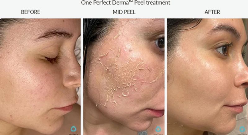 Uneven tone and texture before, mid-peel and after one Perfect Derma Peel. Photo supplied by The Perfect Derma.