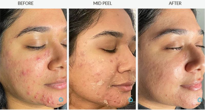 Breakouts on the cheek and jaw before, mid-peel and after a Perfect Derma Peel. Photo supplied by The Perfect Derma.