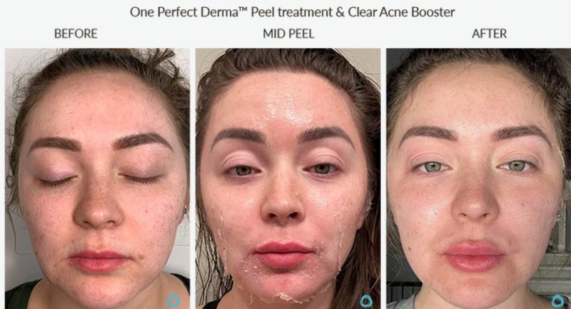 Breakouts before, mid-peel and after one Perfect Derma Peel with Clear Acne Booster. Photo supplied by The Perfect Derma.