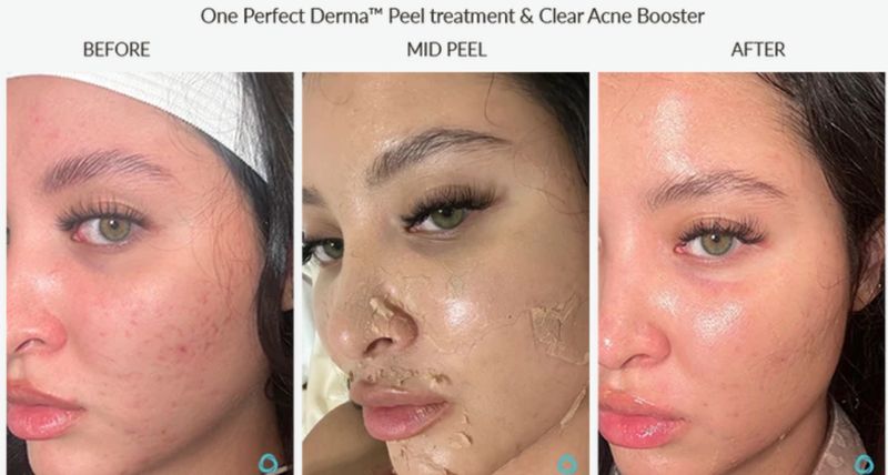 Breakouts and redness before, mid-peel and after one Perfect Derma Peel with Clear Acne Booster. Photo supplied by The Perfect Derma.