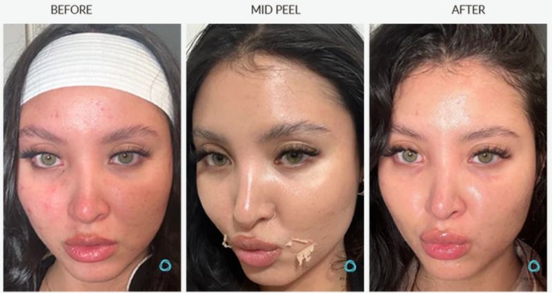 Redness and breakouts before, mid-peel and after a Perfect Derma Peel. Photo supplied by The Perfect Derma.