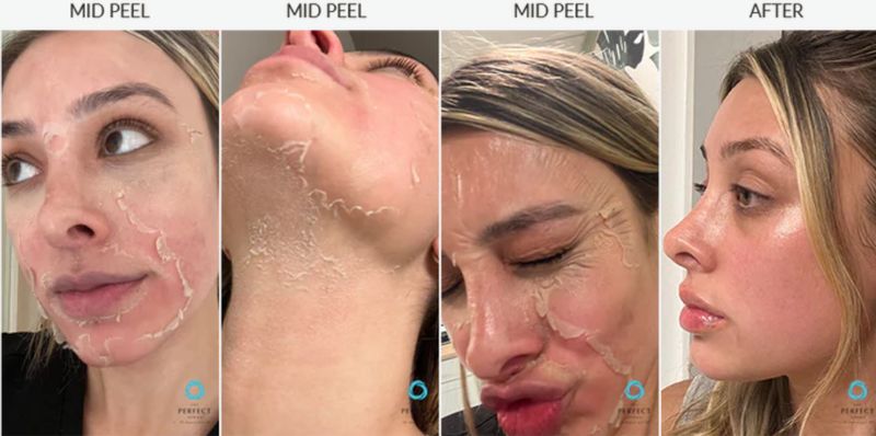 Skin peeling on three different days of a Perfect Derma Peel, and the result after. Photo supplied by The Perfect Derma.