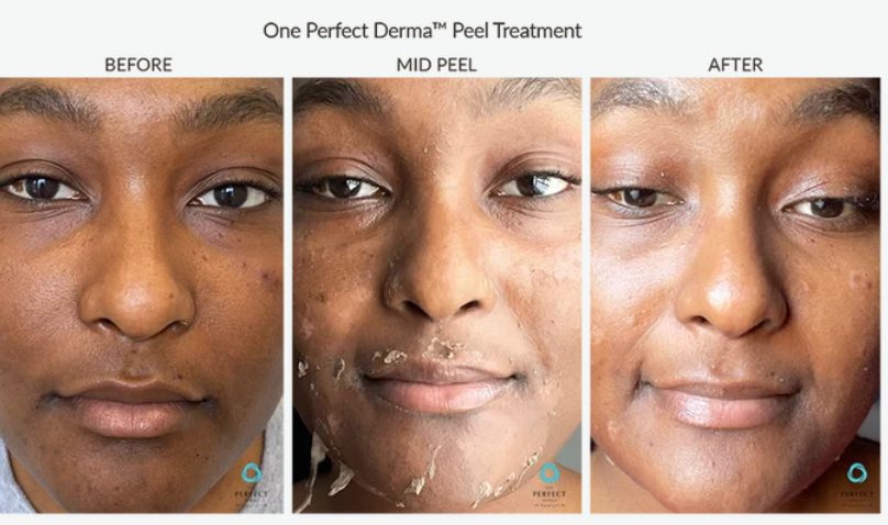 Breakouts and uneven tone before, mid-peel and after one Perfect Derma Peel. Photo supplied by The Perfect Derma.