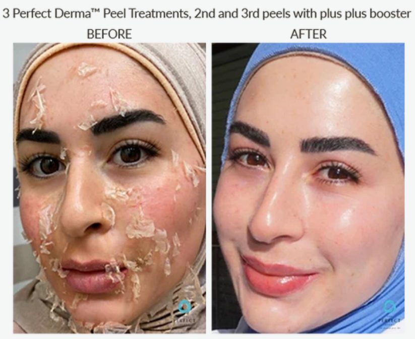 Skin mid-peel and after three Perfect Derma Peel treatments. Photo supplied by The Perfect Derma.