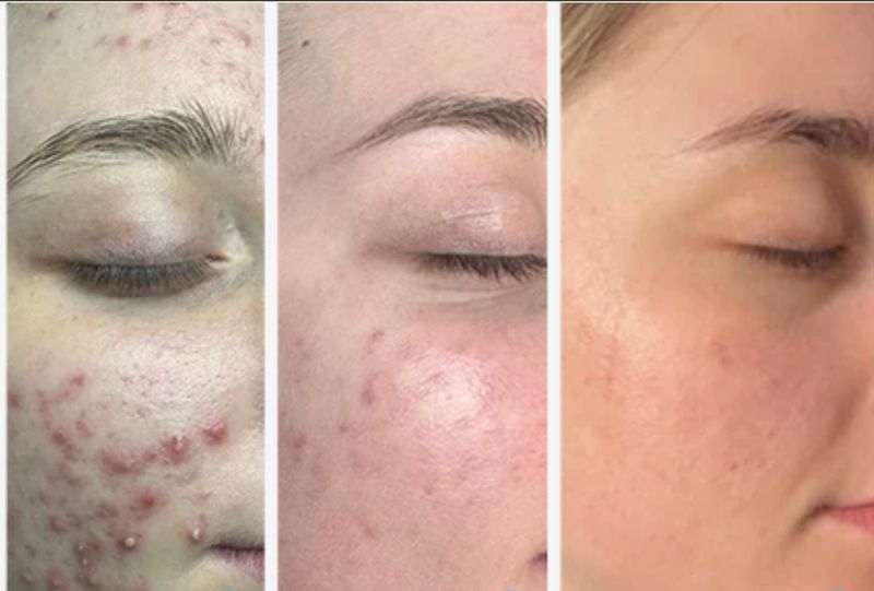 Close-up of cheek breakouts before, mid-peel and after a Perfect Derma Peel. Photo supplied by The Perfect Derma.