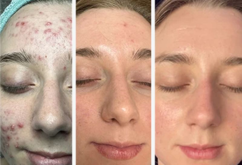 Forehead and cheek breakouts before, mid-peel and after a Perfect Derma Peel. Photo supplied by The Perfect Derma.