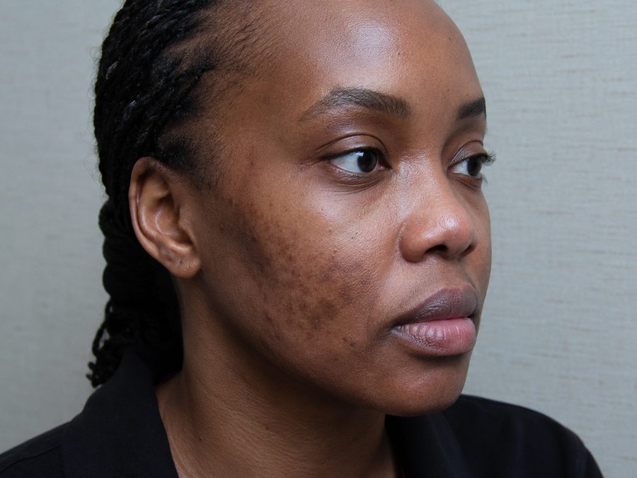 Pigmentation before treatment