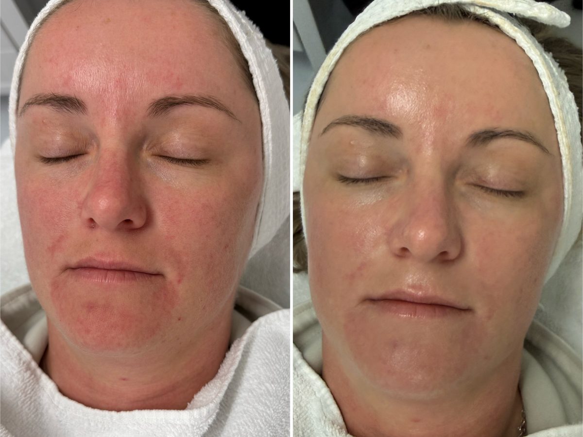 Before and after photos of a Le Miracle client with facial redness, calmer and more even after treatment
