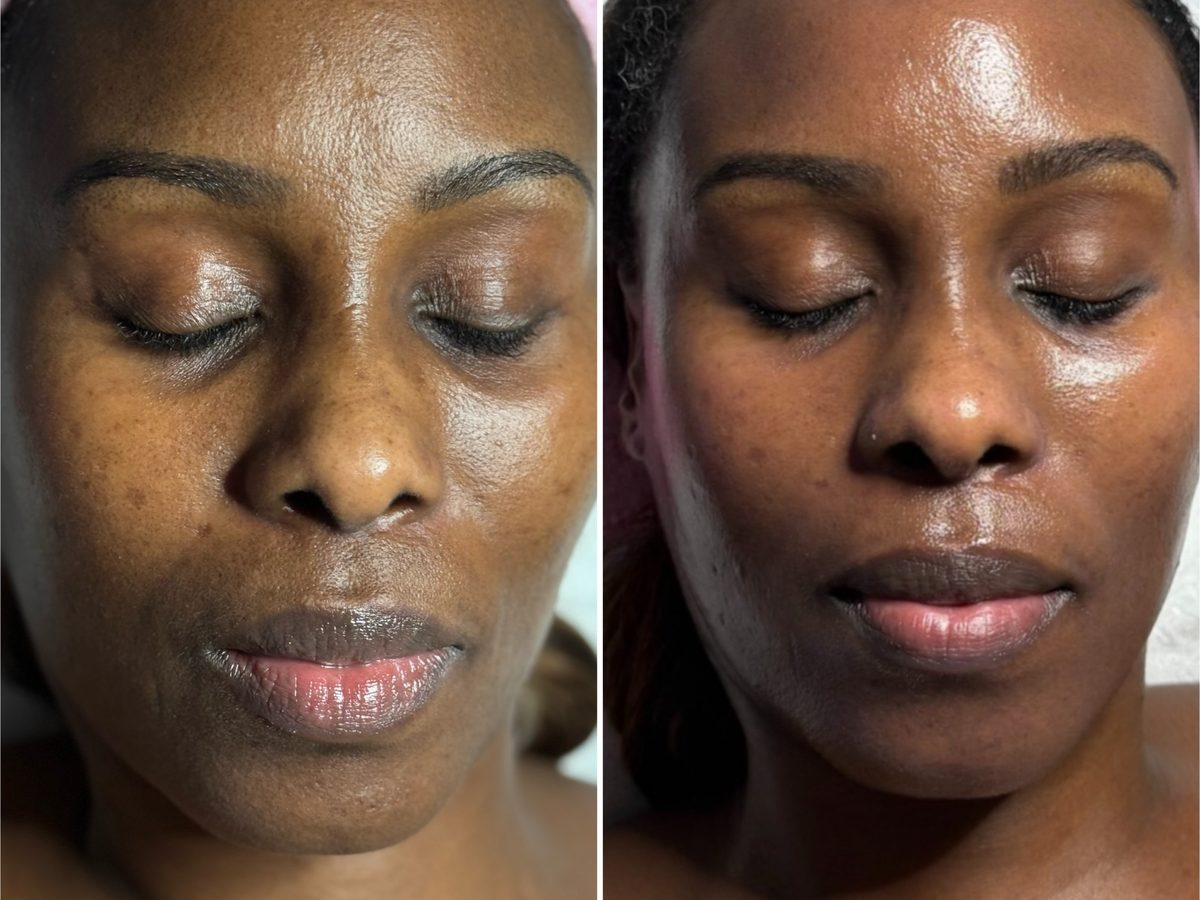 Before and after photos of a Le Miracle client with a deep skin tone, brighter and more even after treatment