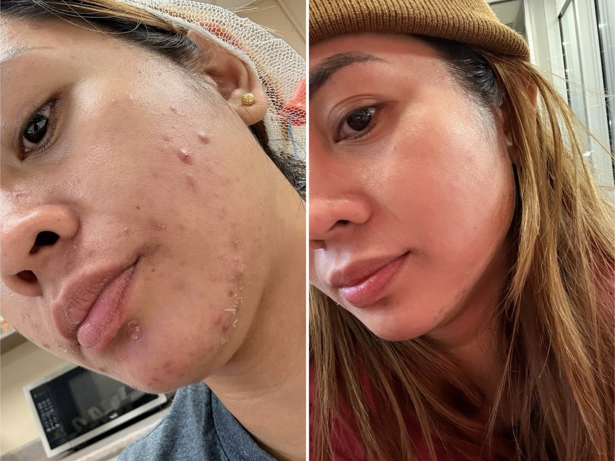 Before and after close-up of a Le Miracle client's cheek with active breakouts, clearer after treatment