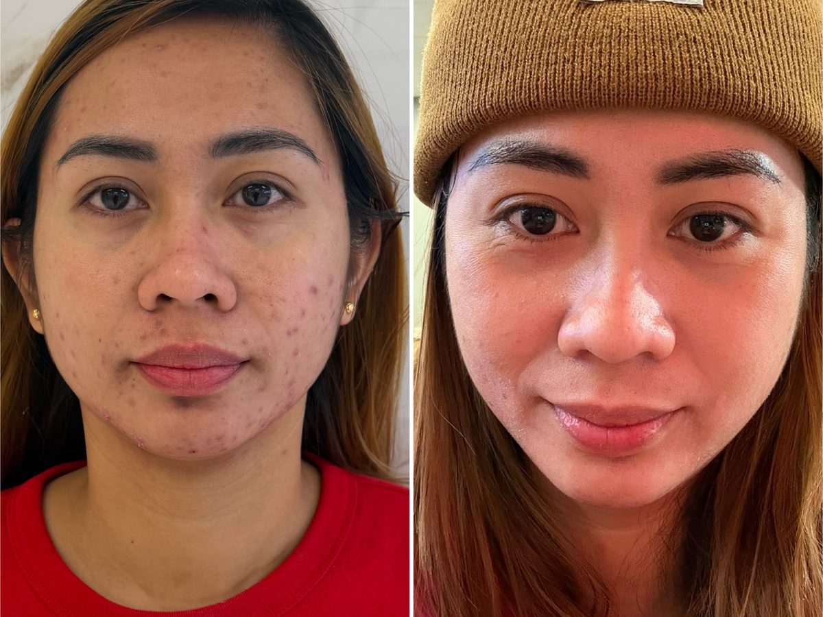 Before and after photos of a Le Miracle client with breakouts and redness, clearer after treatment