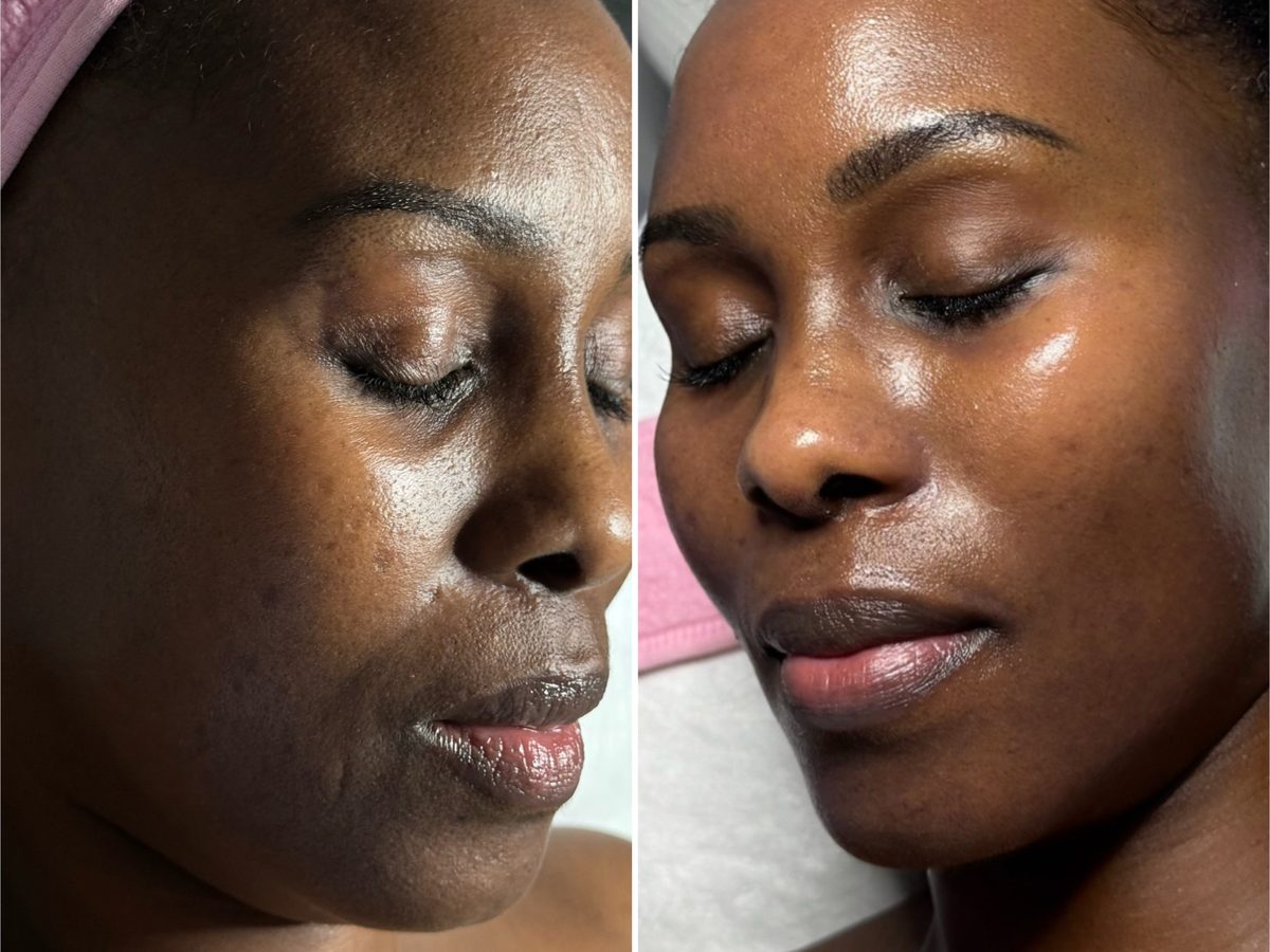 Before and after side profile of a Le Miracle client with a deep skin tone, more radiant after treatment