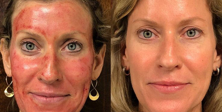 Vampire Facial PRP before and after results at Le Miracle Skin Clinic, Ottawa