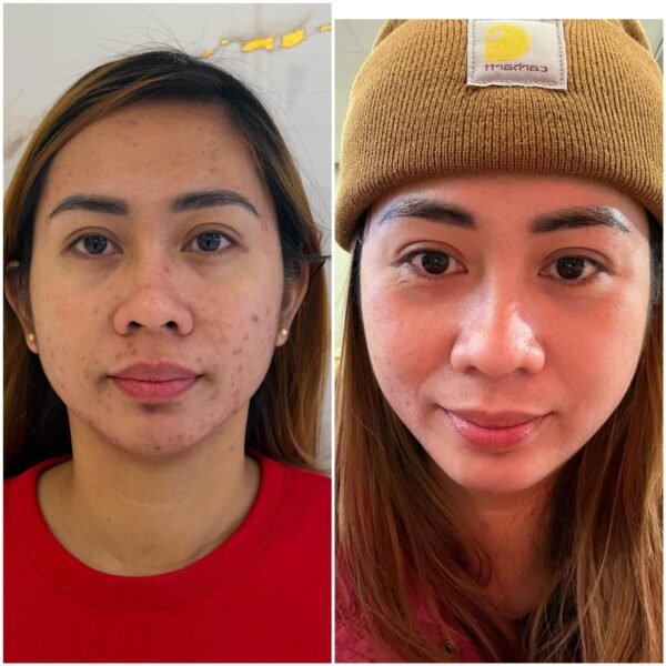 Acne and breakouts