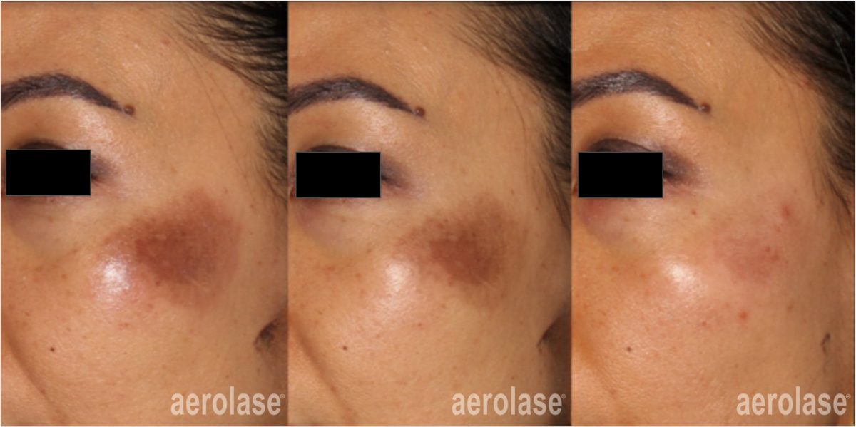 Bruise Treatment in Ottawa at Le Miracle Skin Clinic