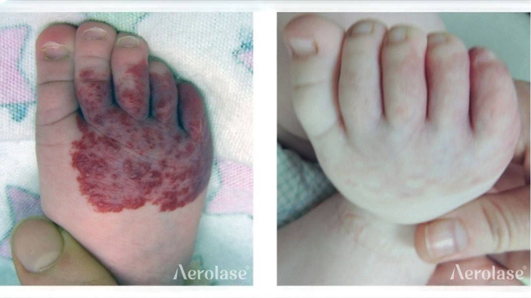 Hemangioma