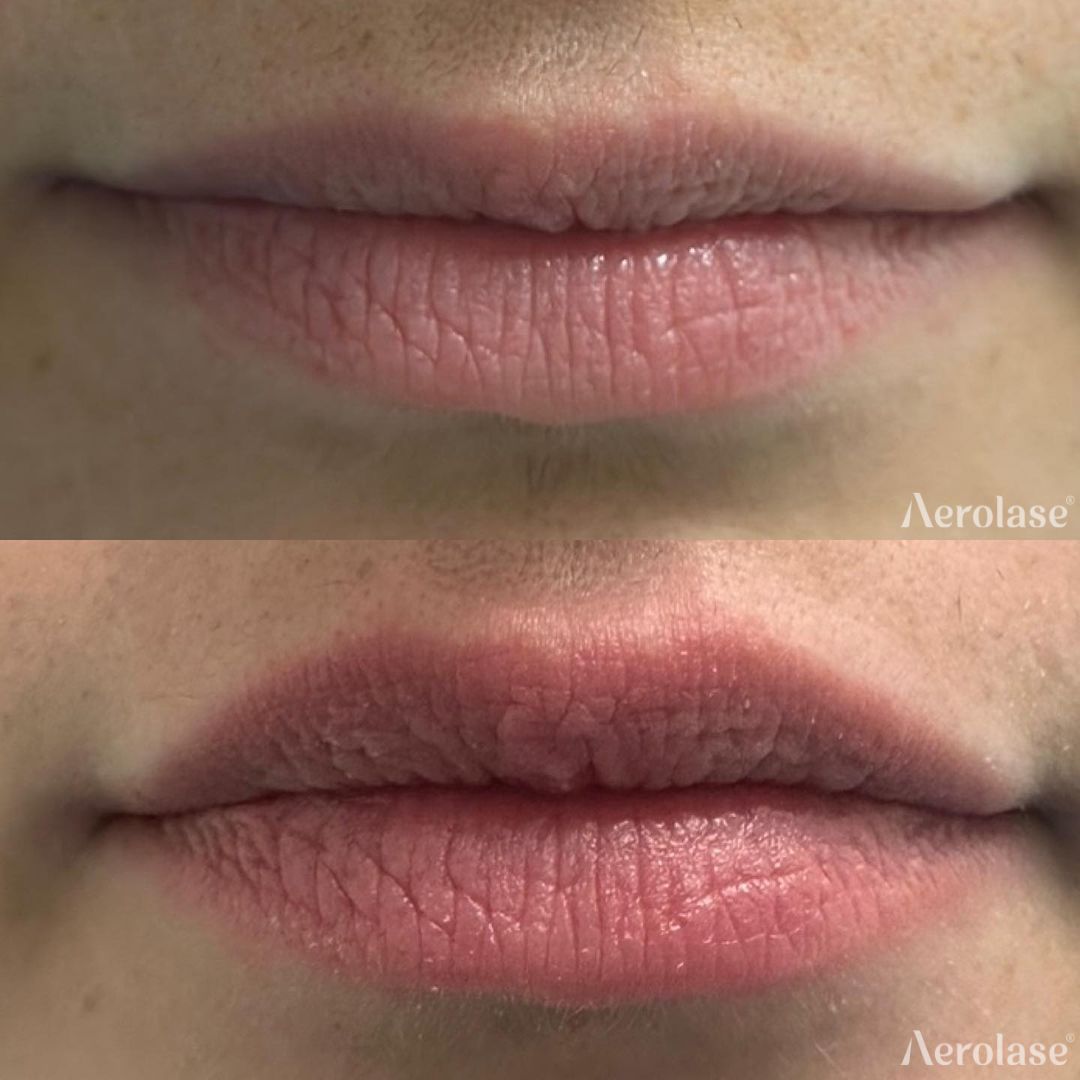 Lip rejuvenation