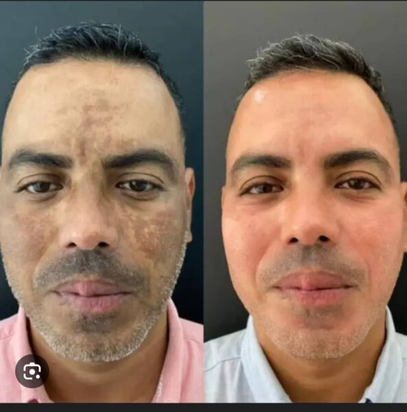 Melasma Treatment in Ottawa at Le Miracle Skin Clinic