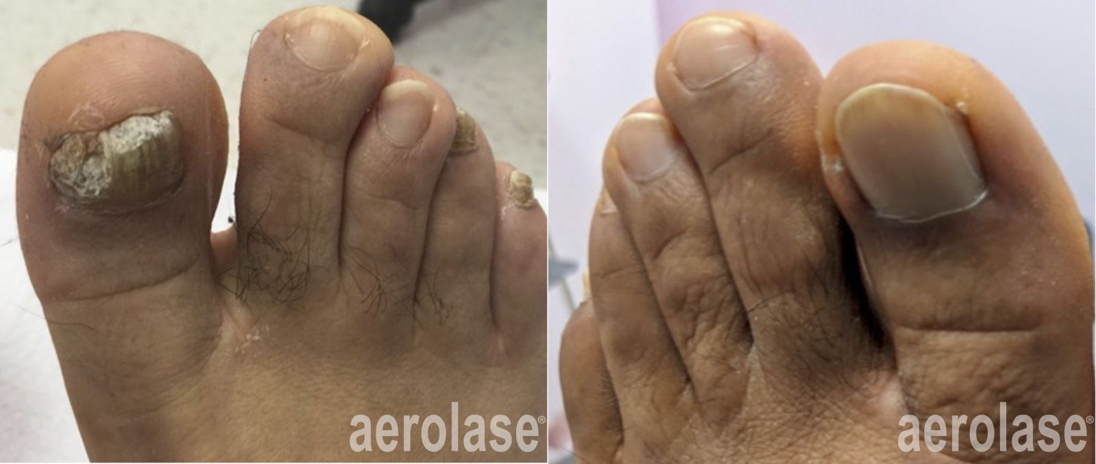 Nail fungus