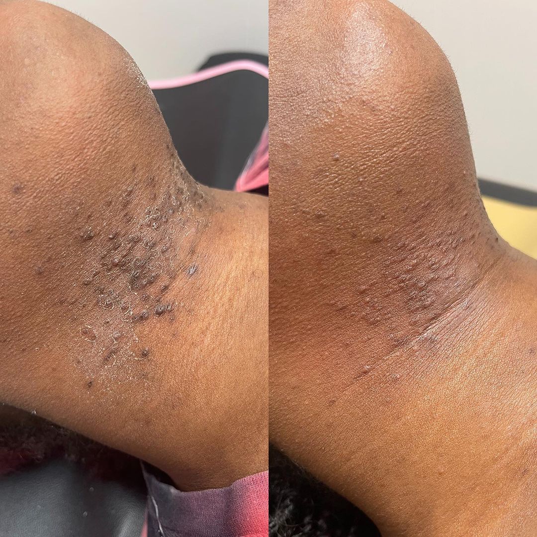 PFB and Razor Bump Treatment in Ottawa at Le Miracle Skin Clinic