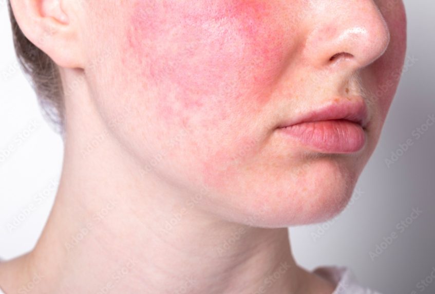 Rosacea and redness