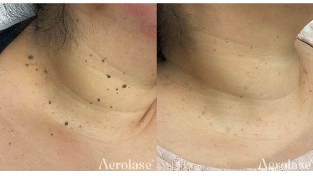 Skin tags