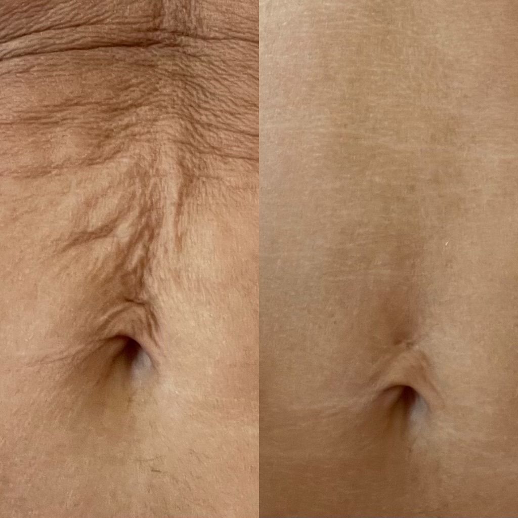 Stretch marks