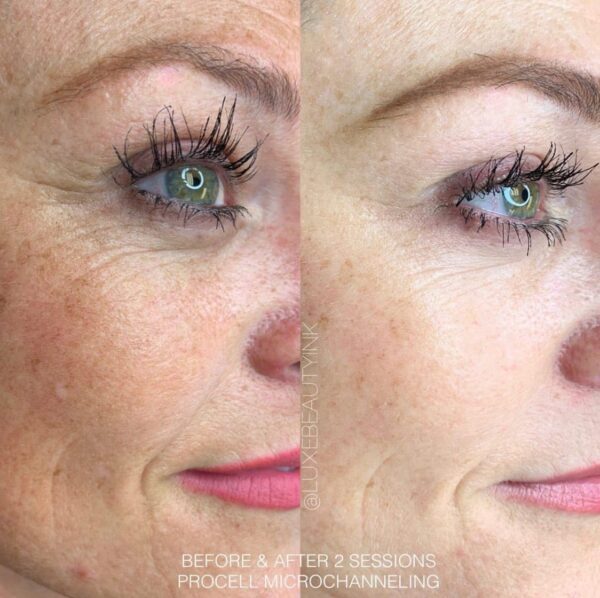 Fine lines and wrinkles